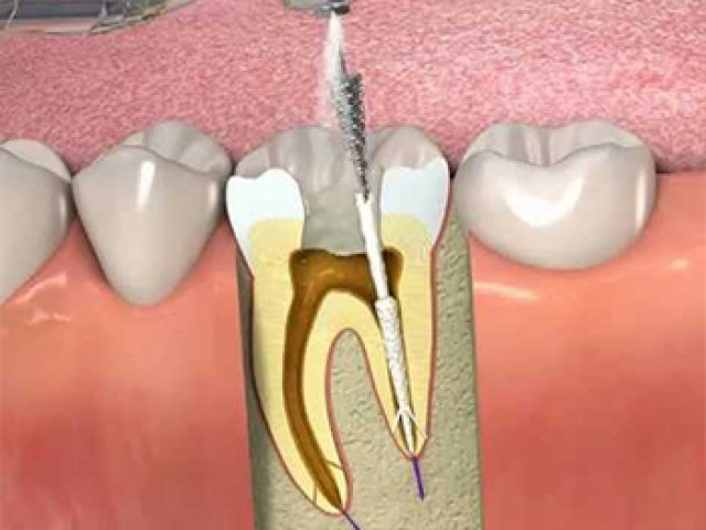 KANAL TEDAVİSİ (ENDODONTİ)